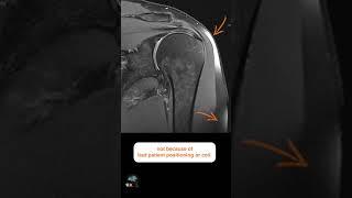 MRI SHOULDER – INHOMOGENEOUS FAT SUPPRESSION