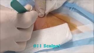 Epidermoid Cyst Removal Procedure (Dr. John Gilmore)
