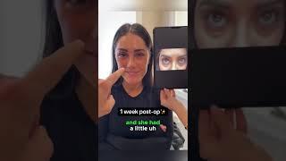 How to get rid of under eye bags #undereyebags #lowerblepharoplasty #lowereyelids #undereyepuffiness