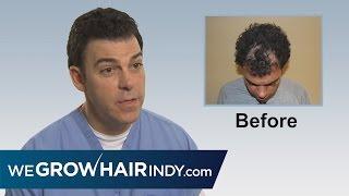 How Dan got his hair back- PAI Medical Group