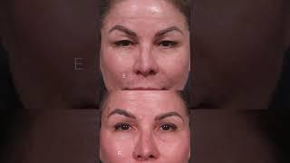Stoker discusses “the Traceless facelift” @DrDavidStoker #beverlyhills #plasticsurgery #surgeons