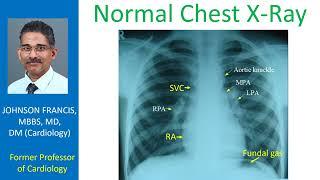 Normal Chest X-Ray