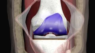 Revision of Knee Replacement Surgery Animation by Cal Shipley, M.D.