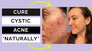 Clear cystic acne naturally - Alexa’s journey on The Clear Code