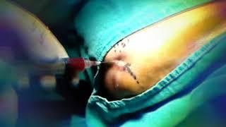 Autologous platelet-rich plasma (PRP) injection in tennis elbow  Dr. Mavropoulos Rodion