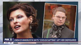 Supermodel Linda Evangelista files lawsuit against 'CoolSculpting' company