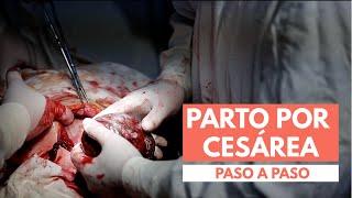 Parto Por Cesárea | Paso A Paso