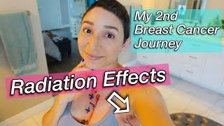 What Are The Real Side Effects Of Radiation Therapy For Breast Cancer