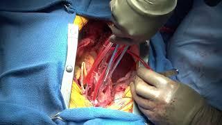 acute type A aortic dissection, s/p esophagectomy, retrosternal gastric tube