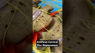 Artificial Cervical Disc Replacement (3D Animation)