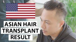 US Patient Asian Type FUE Hair Transplant Result and Consultation for Second Surgery