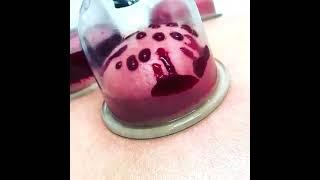 how cupping therapy work's || short video for better understand