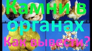 Камни в желчном пузыре, почках и мочевом пузыре - как их вывести