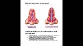 Искривление перегородки носа, септопластика, показания и противопоказания к септопластике.