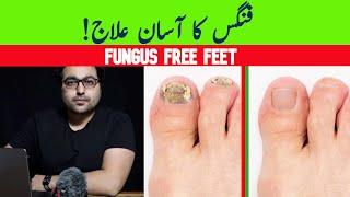 Dr. Zee:Get Rid Of Toenail Fungus: A complete guide