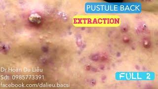 Mụn trứng cá mủ lưng cực nặng|Dermatologist,pimples,whitehead,acne conglobata pustule extrqction 2