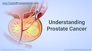 Understanding Prostate Cancer