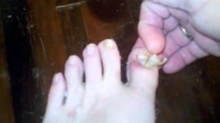 Gross & painful Weak stomach don't watch.