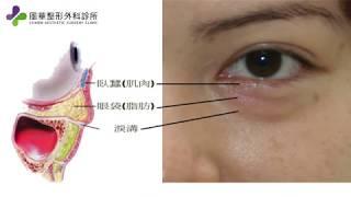 風華整形外科診所高義盛院長-眼袋移位手術說明