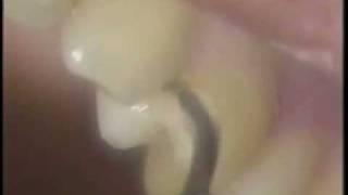 micro ultrasonic teeth cleaning