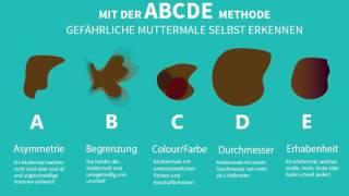 Die ABCDE Methode: So erkennen Sie gefährliche Muttermale selbst