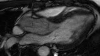 Bicusp SSFP 3ch 12345