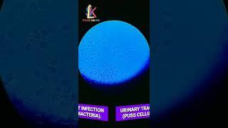 puss cell+bacteria|under microscope.