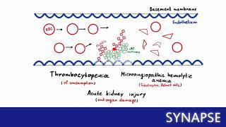 USMLE Step 1 - Тромботическая тромбоцитопеническая пурпура