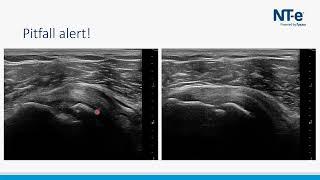 Valkuilen echografie van de schouder - calcificaties