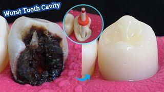 Miraculous Restoration Of Decayed And Broken Tooth! Severe Tooth Caries.