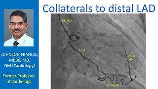 Collaterals to distal LAD