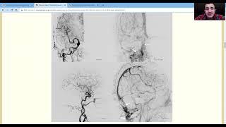 BANANA BITES Cortical Venous Thrombosis -- Putting it Together