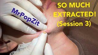 So many pops! See his transformation, previous videos linked in description! Extractions session 3.