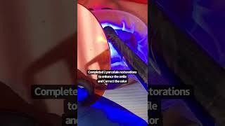 Porcelain veneers procedure | dental crowns procedure porcelain veneers before and after Dr. Yazdan