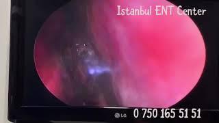 Adenoidectomy with laser