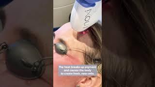 How MOXI Corrects Uneven Pigmentation and Improves Skin Tone | La Jolla Cosmetic