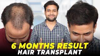 Hair Transplant in Delhi | Best Results & Cost of Hair Transplant in Delhi