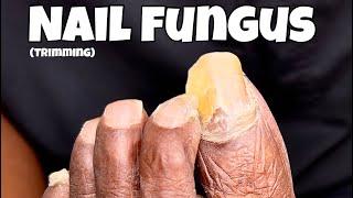 NAIL FUNGUS TREATMENT