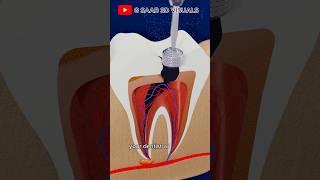 Root Canal Treatment explained in 3d video step by step!