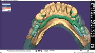 EXOCAD PartialCAD моделировка бюгеля на нижнюю челюсть