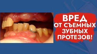 Вред от съемных зубных протезов!