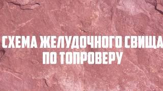 Схема желудочного свища по Топроверу