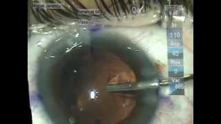 Operacion Ocular Jorge Bolivar