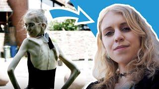 Anorexie: "Ich wog nur noch 34 Kilogramm." | "Ich hatte immer das Gefühl, falsch zu sein..."