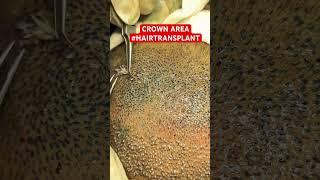 CROWN AREA HAIR TRANSPLANT #hair #crown #hairloss #ytshorts #shorts #hairstyle #drpranilmore