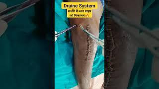 Blood  Draine Sysstemसर्जरी के के बाद जमे हुए ब्लड को निकालने के लिए ड्रेन system 