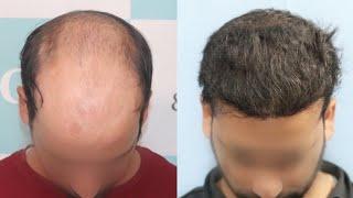 Best Hair Transplant Result 2021 || NW Grade VI || 4,975 Grafts || Regrow Clinic Haridwar