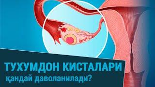 Тухумдон кисталари қандай даволанилади?