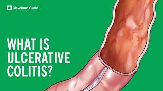 What Is Ulcerative Colitis?