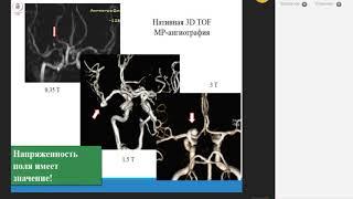 КТ ангиография интракраниальных артерий